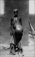 Soudan français : une femme atteinte d’éléphantiasis. – Les manifestations des filarioses lymphatiques sont polymorphes, spectaculaires et très invalidantes. Elles peuvent affecter les membres, les organes ou les parties génitales. Elles sont dues à la prolifération dans le système lymphatique de petits parasites, les filaires, transmis par la piqûre des moustiques. Ces parasites quittent en effet nuitamment les vaisseaux lymphatiques pour gagner la circulation sanguine où ils peuvent être absorbés par des moustiques hématophages, qui propagent ensuite la maladie en piquant une autre personne. En colonisant leur nouvelle victime, les filaires entraînent des poussées de lymphangite aiguë, dont la répétition peut aboutir à un épaississement fibreux de la peau et du tissu sous-cutané, qui à la longue (le parasite a une durée de vie de 15 ans !) donne les déformations monstrueuses qu’on appelle éléphantiasis. La maladie sévit dans les régions tropicales et sub-tropicales. Si la forme chronique, l’éléphantiasis, avait été attribuée à des filaires dès 1872, les médecins français du Corps de santé colonial, qui contribuèrent largement à la connaissance de cette affection, furent un moment divisés sur les causes de ses manifestations aiguës. D’aucuns, dont le docteur Le Dantec qui a donné son nom au premier grand hôpital de Dakar, l’attribuaient à un agent bactérien, le streptocoque, et avaient même envisagé l’existence d’une bactérie spécifique le lymphocoque ou dermocoque, tandis que d’autres penchaient pour un agent parasitaire. Le traitement de la maladie resta longtemps circonscrit à l’ablation chirurgicale des masses fibreuses, opération qu’il fallait renouveler épisodiquement, et il fallut attendre 1947 pour voir apparaître une chimiothérapie anti-filarienne efficace.